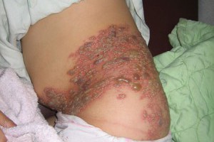 斬皮蛇真的沒有效 @ 三峽樹林【北大特區】 柚子小兒科、過敏氣喘專科診所 :: 痞客邦 PIXNET ::