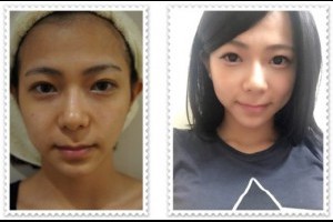 【台中拉皮整型】童顏針及Ulthera極限超音波拉提醫美療程推薦去台中潘朵拉整形外科診所做,效果超好的~讓我的臉變得相當緊緻,終於有蘋果肌啦! @ 世界的天空 :: 痞客邦 PIXNET ::