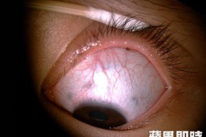 日拋型人工淚液捨不得丟　少女眼睛竟長蟲 | 即時新聞 | 20170103 | 蘋果日報