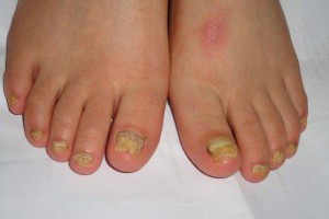 快看！惱人的灰指甲，竟然只要1個小處方就能立即改善！ z9x9