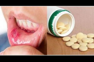 口腔潰瘍總是不好? 嘴巴都爛了! 2片葯治好了, 一瓶才三四塊錢!