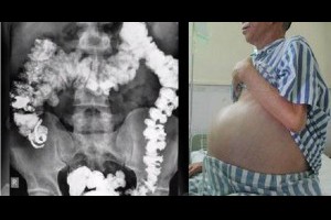 爽快！史上最強「排黑便」法，不吃藥一排就是5公斤！半個月清一次腸胃更健康！