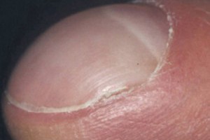 指甲變形疾病跟著來！快看這11種「指甲」你也有嗎？ | ETNEWS健康雲 | ETNEWS新聞雲