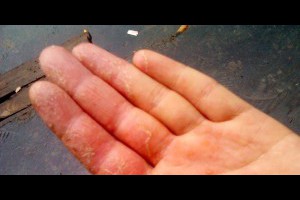 手指脫皮表示你得了這四種病的其中一種！ - 未分類文章 - 月光仙子