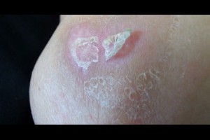 傷口結痂很癢怎麼辦？「四種方法」教你快速去痂！真的很猛，再也不會亂摳啦！ 