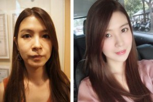 【台中醫美推薦】價格／技術／醫師介紹●打肉毒微整推薦找專業整形外科診所，玻尿酸打下巴效果超美超滿意！ @ 陽光彩虹 :: 痞客邦 ::
