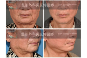 全方位拉皮手術法 - 高位筋膜懸吊中下臉拉皮 - 整形外科吳至偉醫師 - 凡登整形外科
