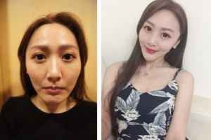 【肉毒台中】推薦醫美診所微整形◆玻尿酸、肉毒都是知名大廠牌，醫師專業又令人感到安心～ @ 用盡全力吧！ :: 痞客邦 ::