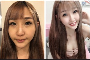 【玻尿酸下巴】玻尿酸下巴讓我變美美v字臉→最推醫美診所! @ Wan-Ju's 樂活部落::: :: 痞客邦 ::