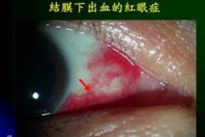 眼白出現血塊，別以為過幾天就沒事了！眼科醫師：這3種眼睛問題，就是腦中風警訊-陳瑩山醫師的護眼隨筆-良醫健康網