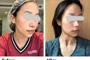 Picocare 皮秒雷射，皮秒推薦 -司鉑診所