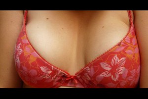 二次隆乳手術，隆乳重做費用，哪種二次隆乳方式好？＠整形外科吳至偉醫師 | Motiva隆乳手術 二次隆乳 提乳 縮胸手術 乳房重做