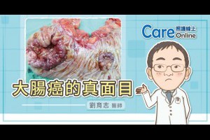  大腸癌的真面目（真實照片，慎入） - 照護線上 