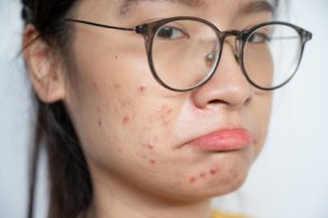 臉[冒5大症狀]可能是蠕形蟎蟲太多了!醫提醒:別再加強清潔保養.做1事才有用_透視疾病_文章專區 | 常春月刊--全宇宙最實用的保健知識