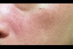 保養大誤解》臉上狂出油卻常脫皮，都是保濕不夠？皮膚科醫師：錯！你該做的是... - 良醫健康網