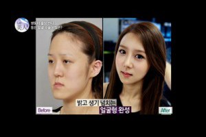 咬合矯正　戽斗也能變正妹 - 牙科知識小鋪 - PChome 個人新聞台
