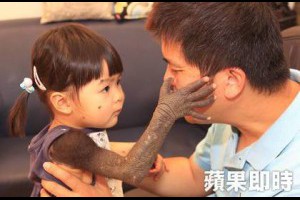 【獨家】超萌！　2歲琪琪勇抗黑痣罕病　　