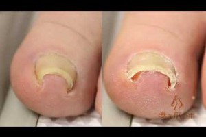 腳趾甲向內生長變形該怎麼辦？這是我看過最酷的方式！
