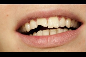 孩子意外跌斷牙齒，第一件要做的事是把牙齒浸在「冰牛奶」中？(牙科,黃秀美,名醫,王士豪,柳伯鴻) - 名醫一點通 - 新知 - 良醫健康網 - 商業周刊（百大良醫）