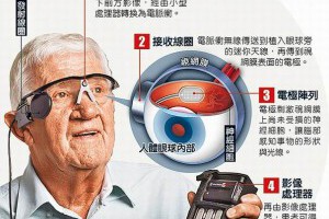 黃斑病變仿生眼救視力